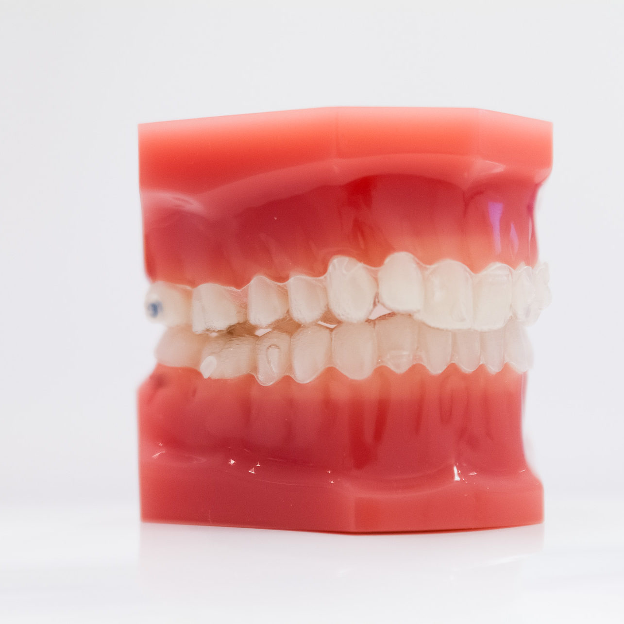 Système invisalign pratique utiliser par le cabinet Naegelen Kingersheim