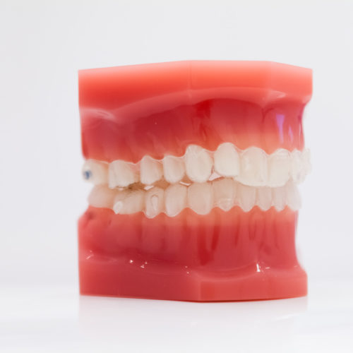 Système invisalign pratique utiliser par le cabinet Naegelen Kingersheim