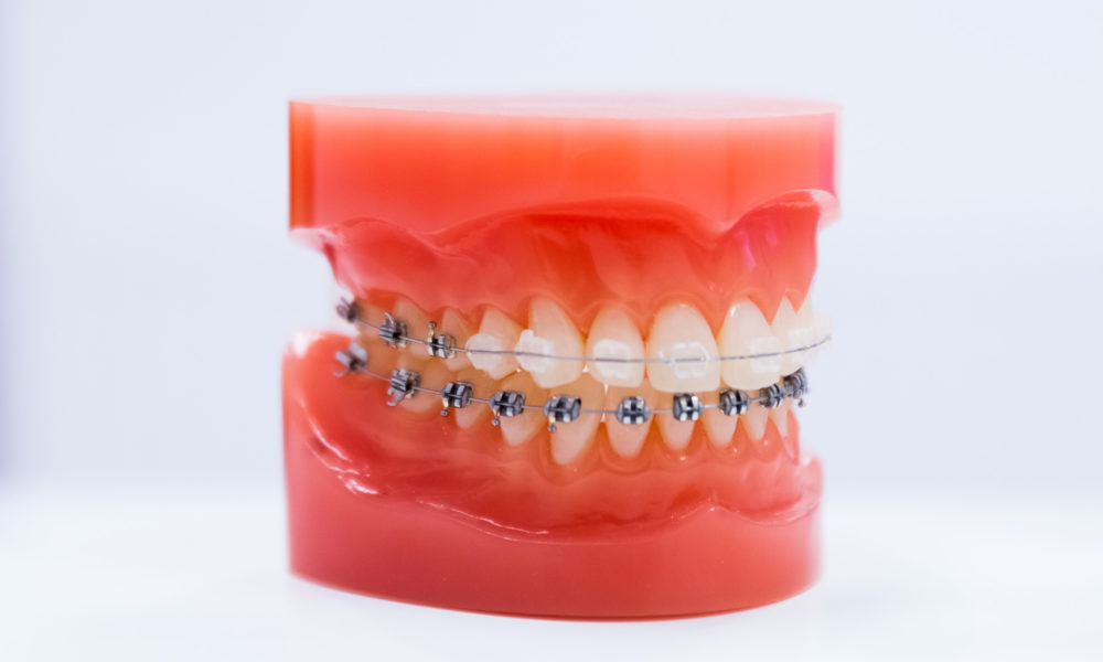 Appareil dentaire transparent et métallique cabinet Naegelen à Kingersheim