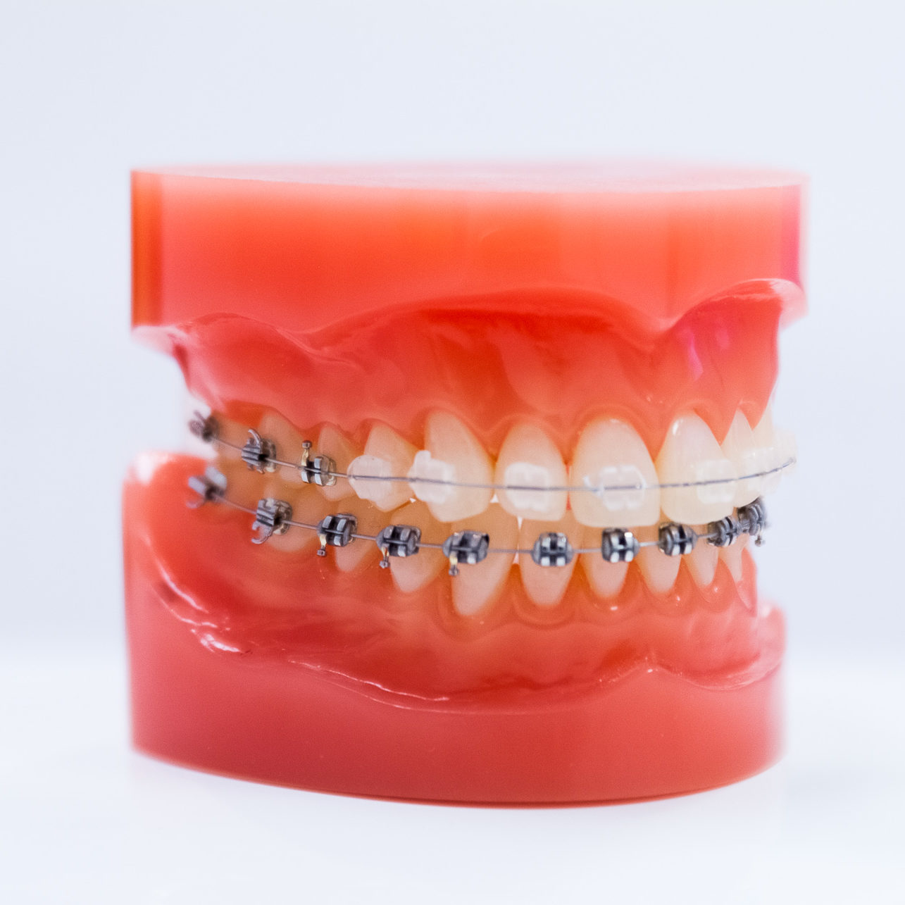 Appareil dentaire transparent et métallique cabinet Naegelen à Kingersheim