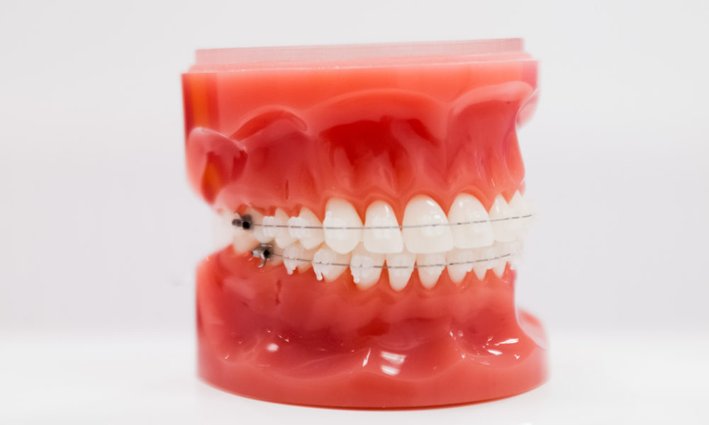 cabinet Naegelen à kingersheim pratique l'orthodontie vestibulaire transparent