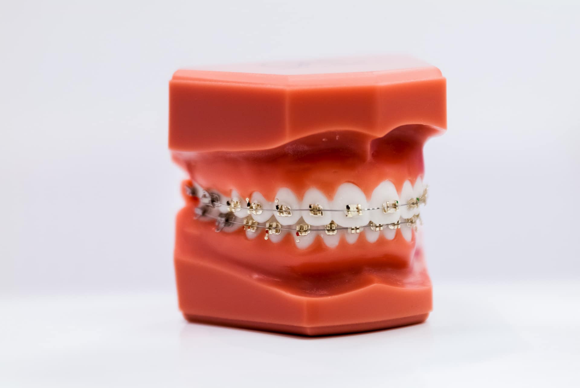 Orthodontie vestibulaire métallique orthodontie vestibulaire Or Cabinet Kingersheim Naegelen