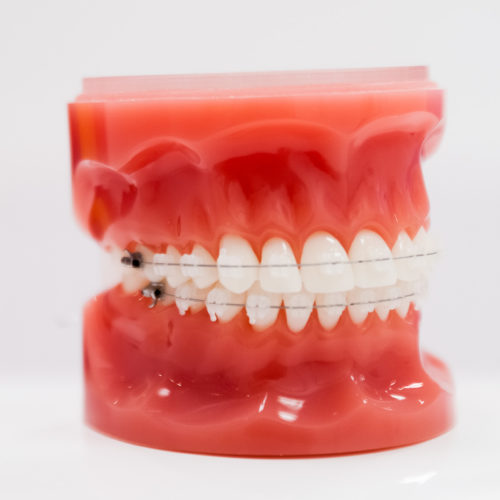 cabinet Naegelen à kingersheim pratique l'orthodontie vestibulaire transparent