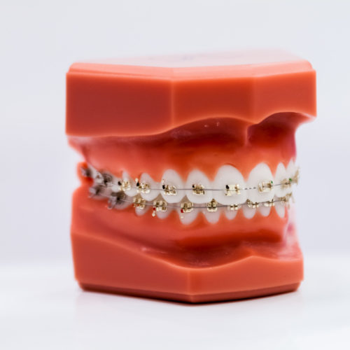 orthodontie vestibulaire Or Cabinet Kingersheim Naegelen