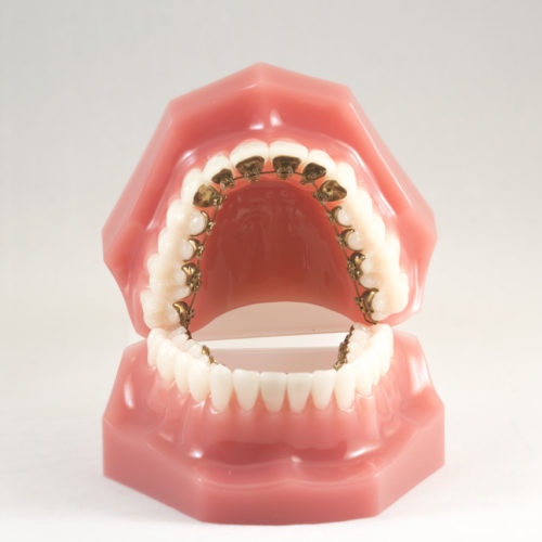 Orthodontie linguale